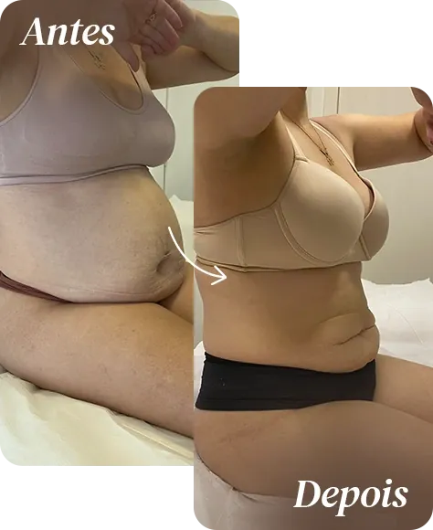 Resultado de tratamento corporal na AllMãe