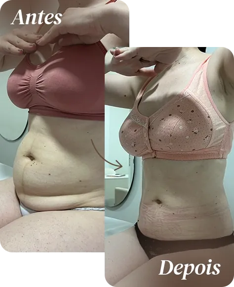 Resultado de tratamento corporal na AllMãe