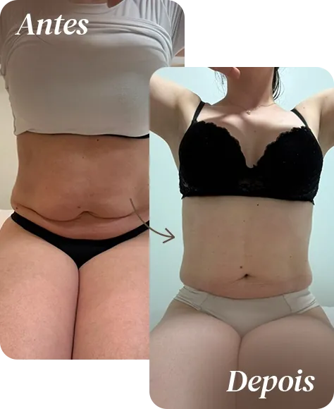 Resultado de tratamento corporal na AllMãe