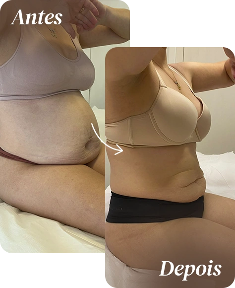 Antes e depois de tratamento corporal na AllMãe