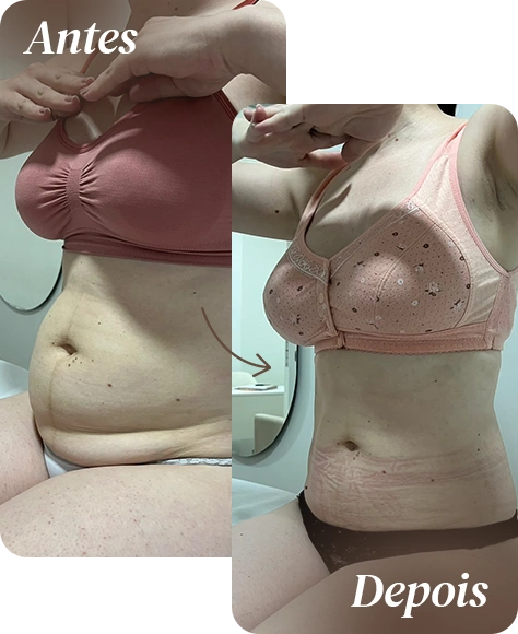 Antes e depois de tratamento corporal na AllMãe
