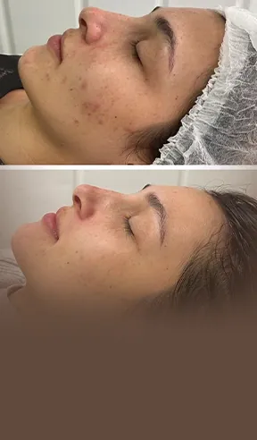 Peelings e tratamentos faciais na AllMãe