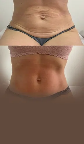Tratamento de flacidez corporal e facial na AllMãe