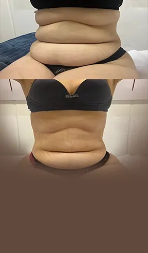 Tratamento de gordura localizada na AllMãe