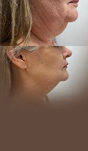 Lifting de papada e dos seios na AllMãe